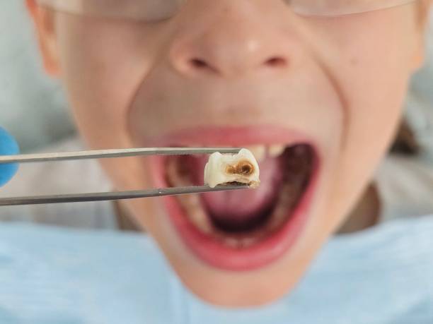Best Emergency Dental Extractions in Wlow Springs, IL